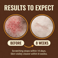 Rebalance Yeast Overgrowth in Just 14 Days with Pau D'arco & Ginger